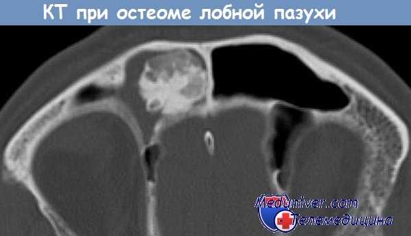 КТ при остеоме лобной пазухи