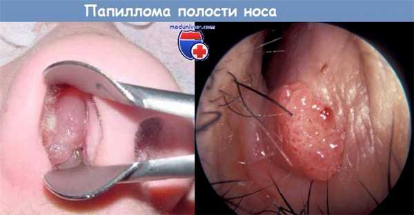 Папиллома полости носа