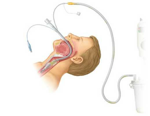 Оротрахеальная интубация 