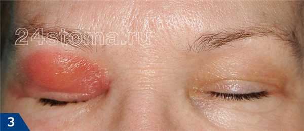 Отек и покраснение век правого глаза при гнойном правостороннем этмоидите