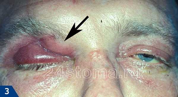 Обострение хронического гнойного фронтита (прорыв гноя из пазухи в область верхнего века)