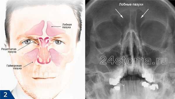 Лобная пазуха вид на схеме и на рентгеновском снимке черепа (вид спереди)