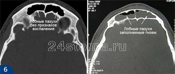Компьютерная томография: слева здоровые лобные пазухи, справа - лобные пазухи, заполненные гноем.
