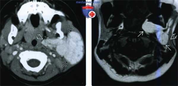 КТ, МРТ при младенческой гемангиоме головы и шеи