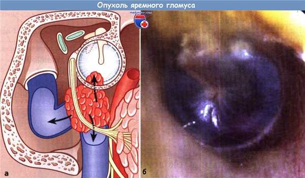 Гломусная опухоль уха