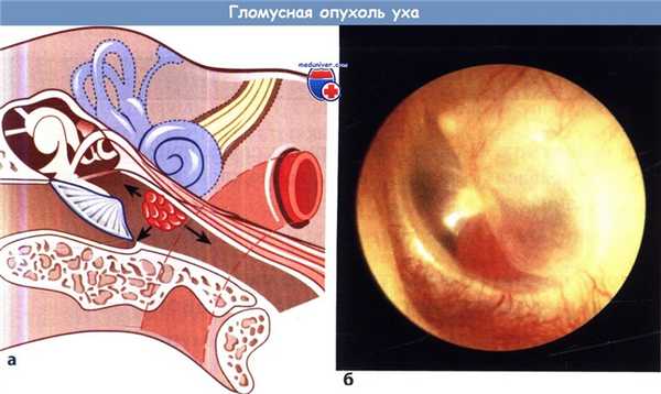 Гломусная опухоль уха