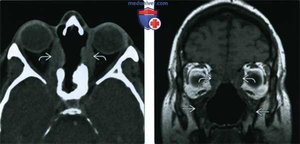 КТ, МРТ при гранулематозе с полиангиитом (Вегенера) носа, пазухи