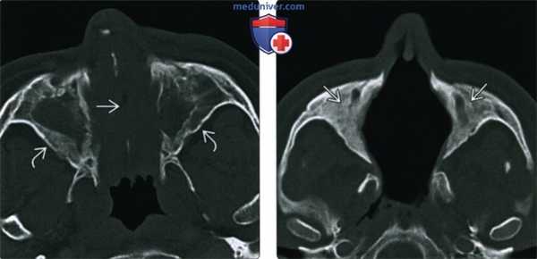 КТ, МРТ при гранулематозе с полиангиитом (Вегенера) носа, пазухи