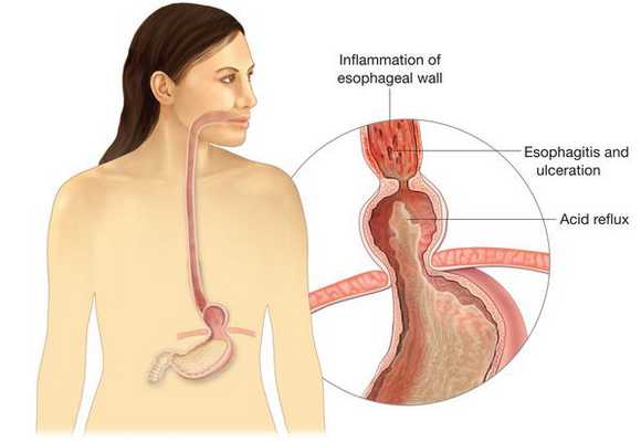 Проникновение пищи из желудка обратно в пищевод