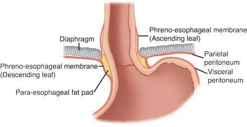 Тракционный фактор развития грыжи
