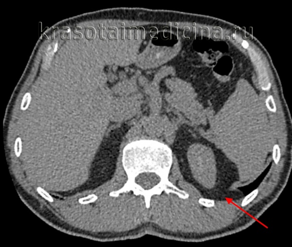КТ ОБП. Диафрагмальная грыжа Бохдалека слева, связанная с истончением мышцы диафрагмы в задне-медиальных отделах с пролабированием забрюшинной клетчатки в краниальном направлении.