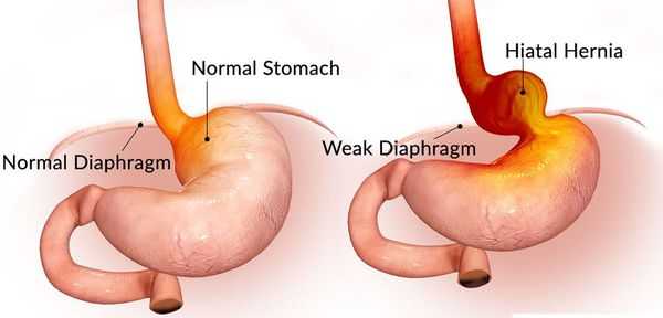 Смещение пищевода в грудную полость