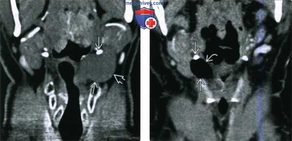 КТ, МРТ при ларингоцеле
