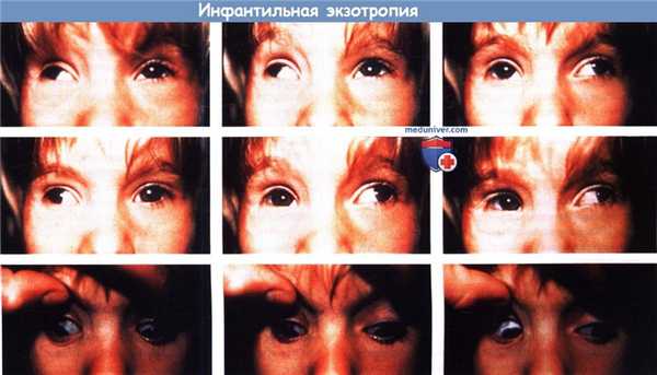 Косоглазие