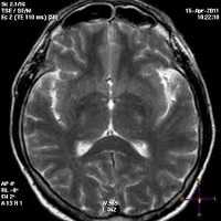Всё о поражении головного мозга