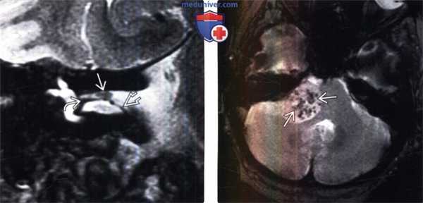 МРТ признаки вестибулярной шванномы