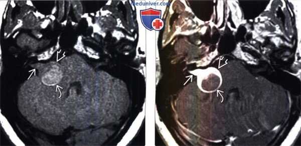 МРТ признаки вестибулярной шванномы