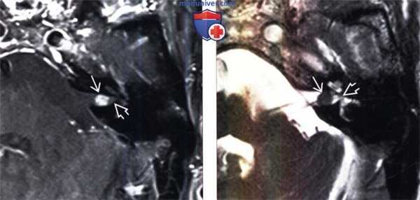 МРТ признаки вестибулярной шванномы