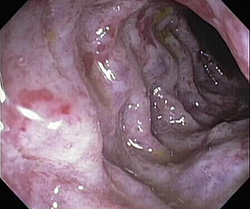 Ишемический колит колоноскопия