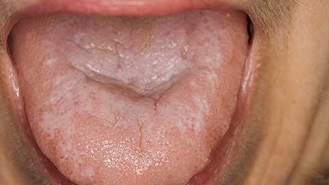 Красный плоский лишай полости рта