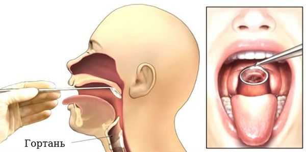Ларингоскопия
