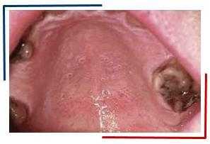 Лейкоплакия курильщиков