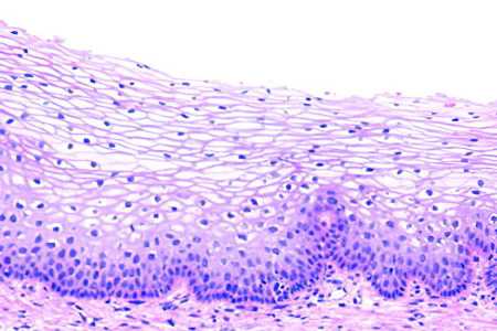 Причины лейкоплакии