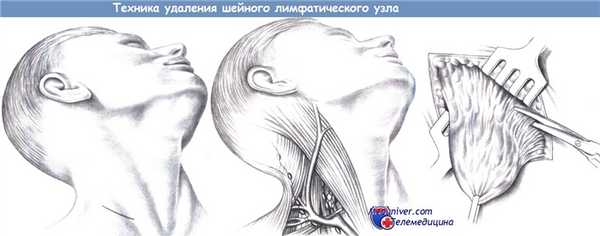 Этапы и техника удаления шейного лимфатического узла