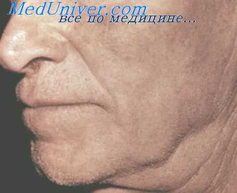 лимфаденит при туберкулезе