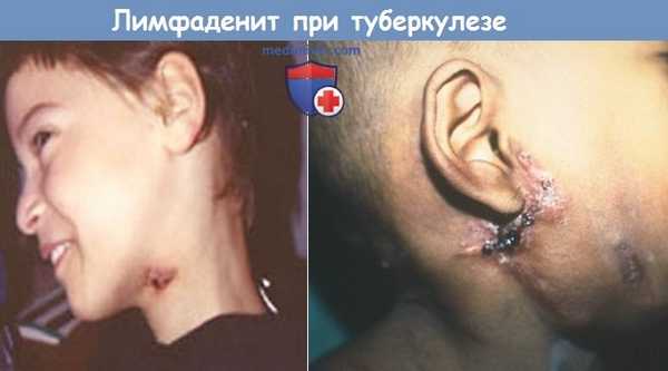 Лимфаденопатия при туберкулезе