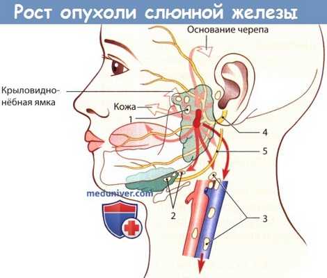 Рост опухоли слюнной железы