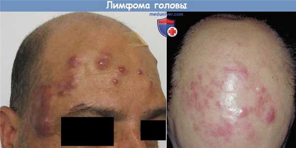 Лимфома головы
