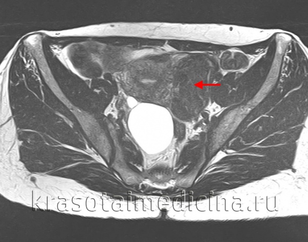 Множественная миома матки