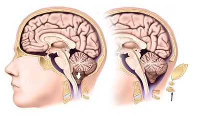 Риногенные внутричерепные осложнения