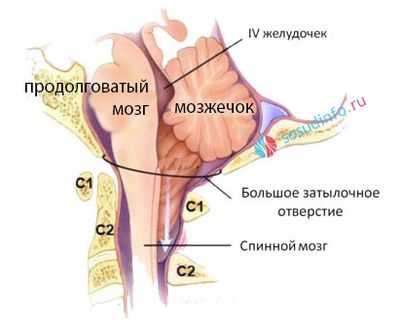 Аномалия Киари