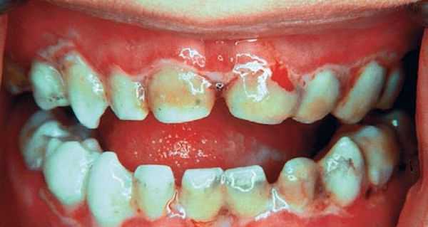 Язвенно-некротический стоматит Венсана