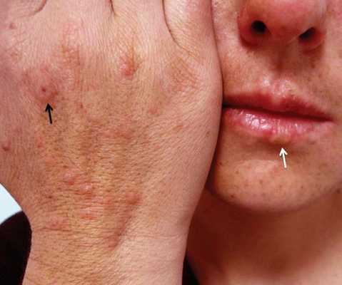 Герпес-ассоциированная МЭЭ