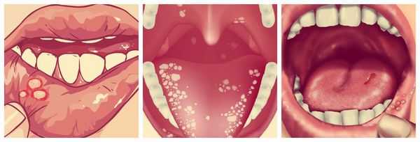 Пузырьки при стоматите