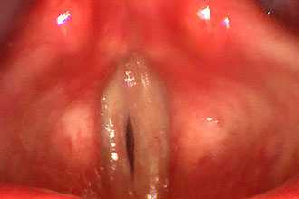 Сибиреязвенный ларингит