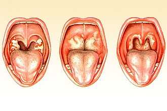 Гриппозный ларингит