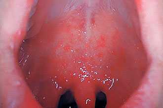 Коревой ларингит