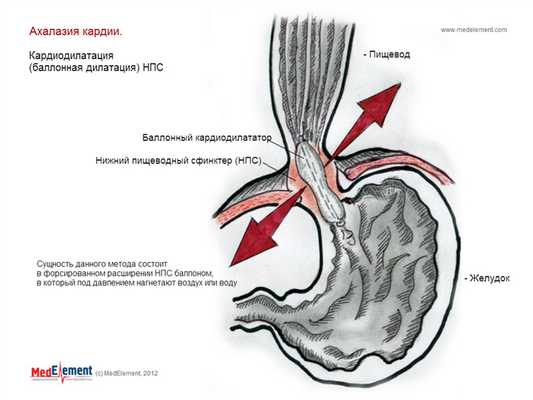 Ахалазия кардии. Лечение (баллонная дилатация (кардиодилатация))