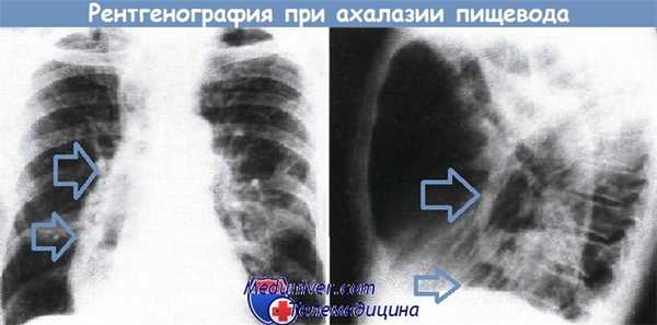 Ахалазия пищевода