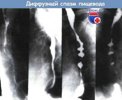 Диффузный спазм пищевода