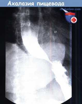 Ахалазия пищевода