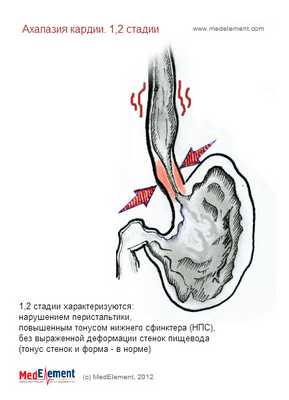 Ахалазия кардии. Классификация. 1 и 2 стадии развития.
