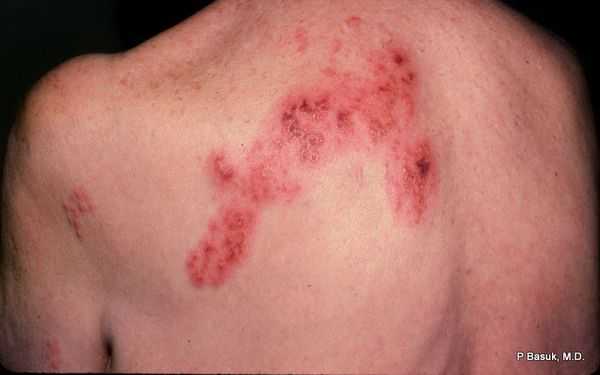 Образовавшиеся корочки