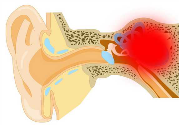 Лабиринтит