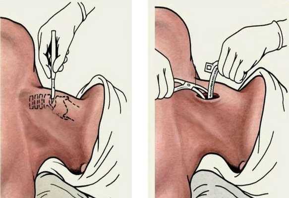 Трахеотомия