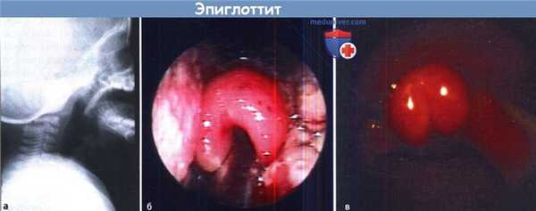 Эпиглоттит